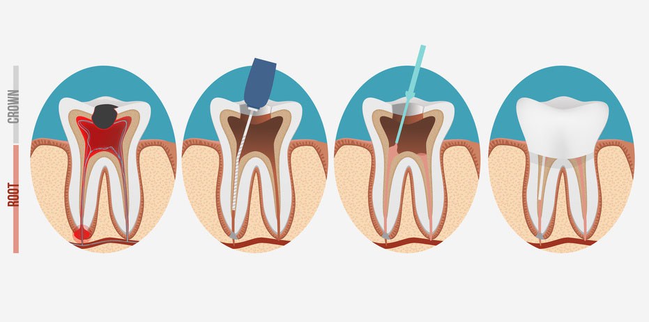 Root canal process